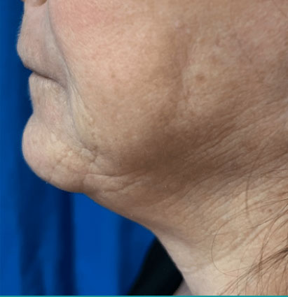 before vein treatment