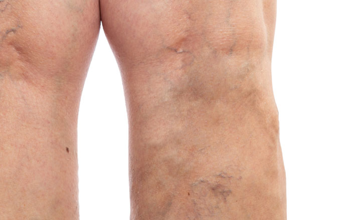 before vein treatment